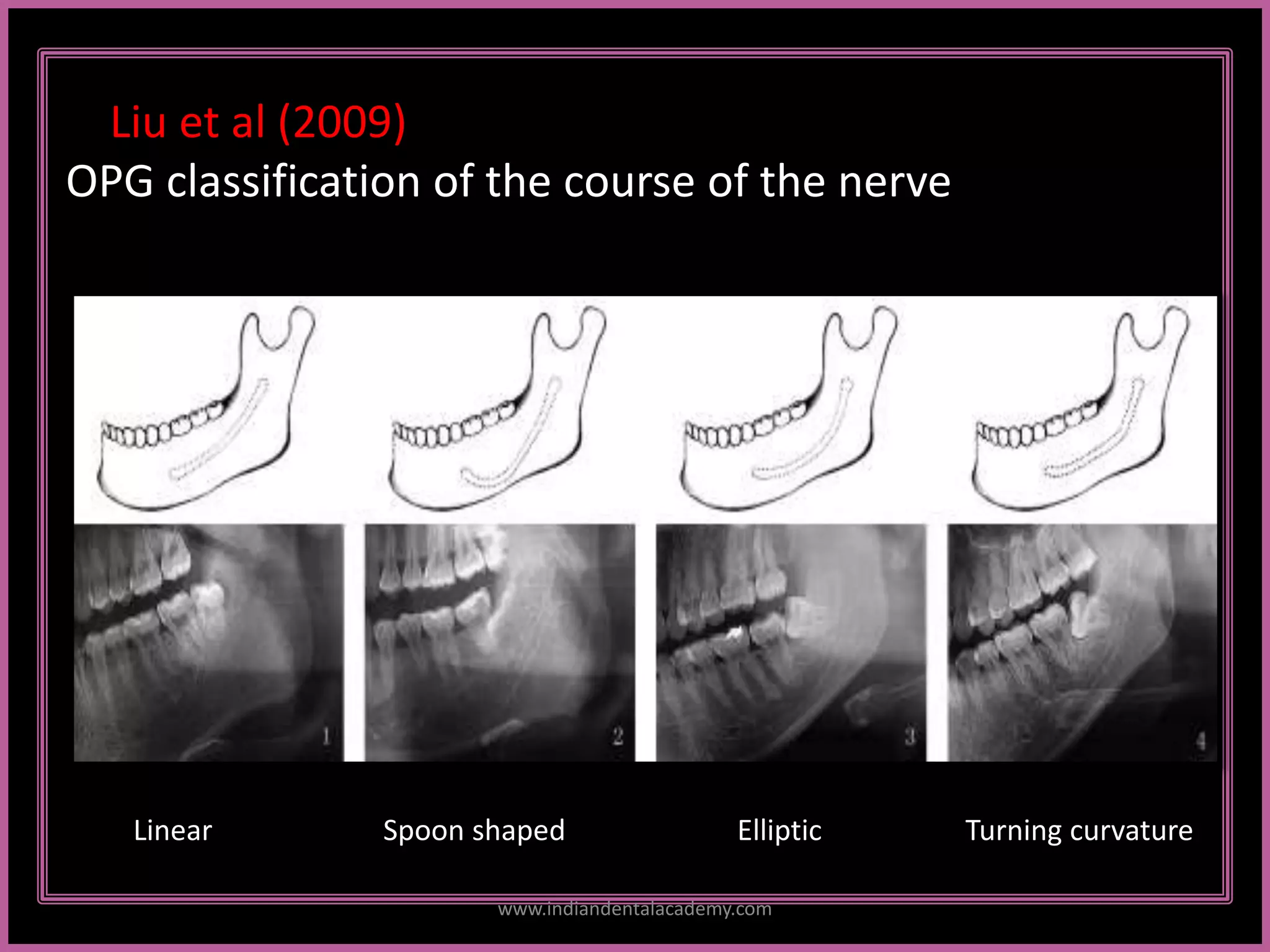 Liu et al (2009)
OPG classification of the course of the nerve
Linear Spoon shaped Elliptic Turning curvature
www.indiandentalacademy.com
 