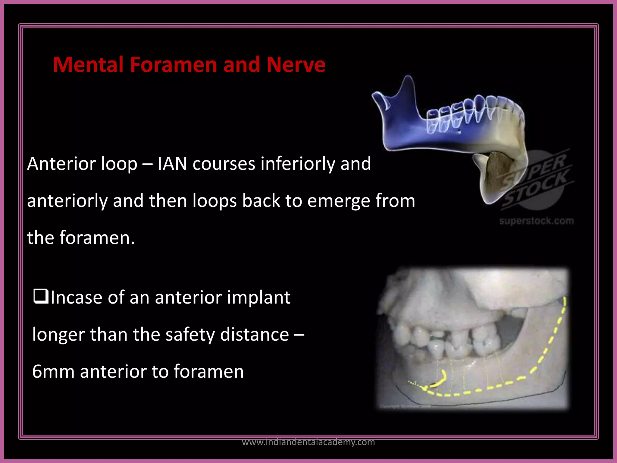 Mental Foramen and Nerve
Anterior loop – IAN courses inferiorly and
anteriorly and then loops back to emerge from
the foramen.
Incase of an anterior implant
longer than the safety distance –
6mm anterior to foramen
www.indiandentalacademy.com
 