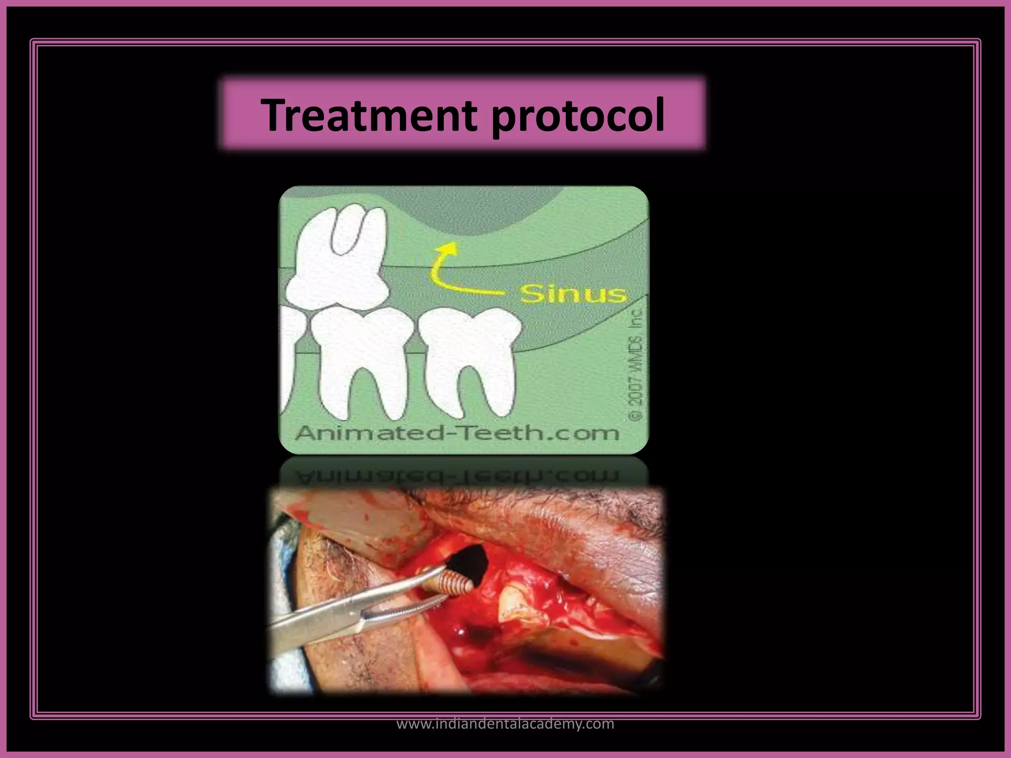 Treatment protocol
www.indiandentalacademy.com
 