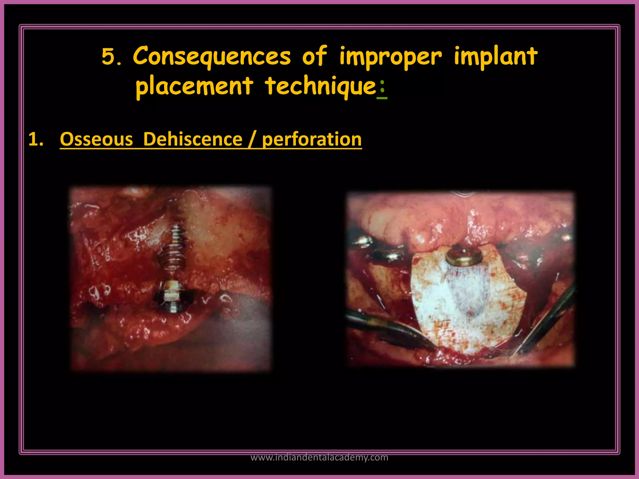2
5. Consequences of improper implant
placement technique:
1. Osseous Dehiscence / perforation
www.indiandentalacademy.com
 