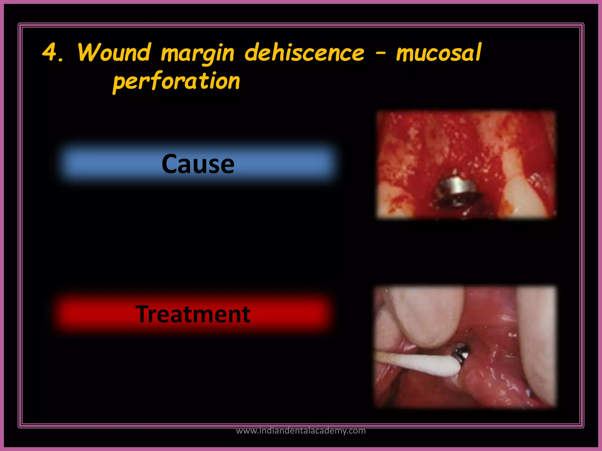 4. Wound margin dehiscence – mucosal
perforation
Cause
Treatment
www.indiandentalacademy.com
 