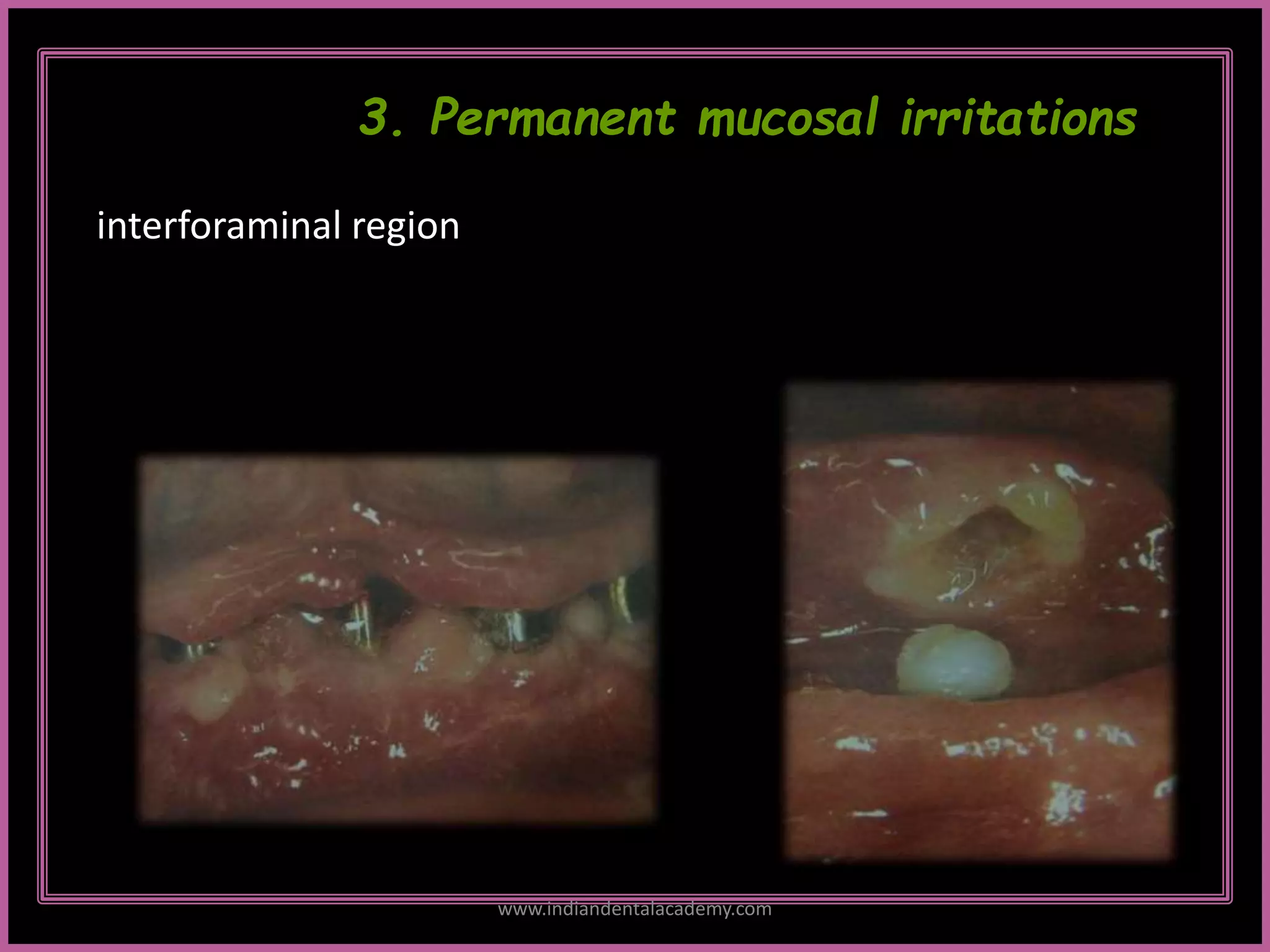 2
3. Permanent mucosal irritations
interforaminal region
www.indiandentalacademy.com
 