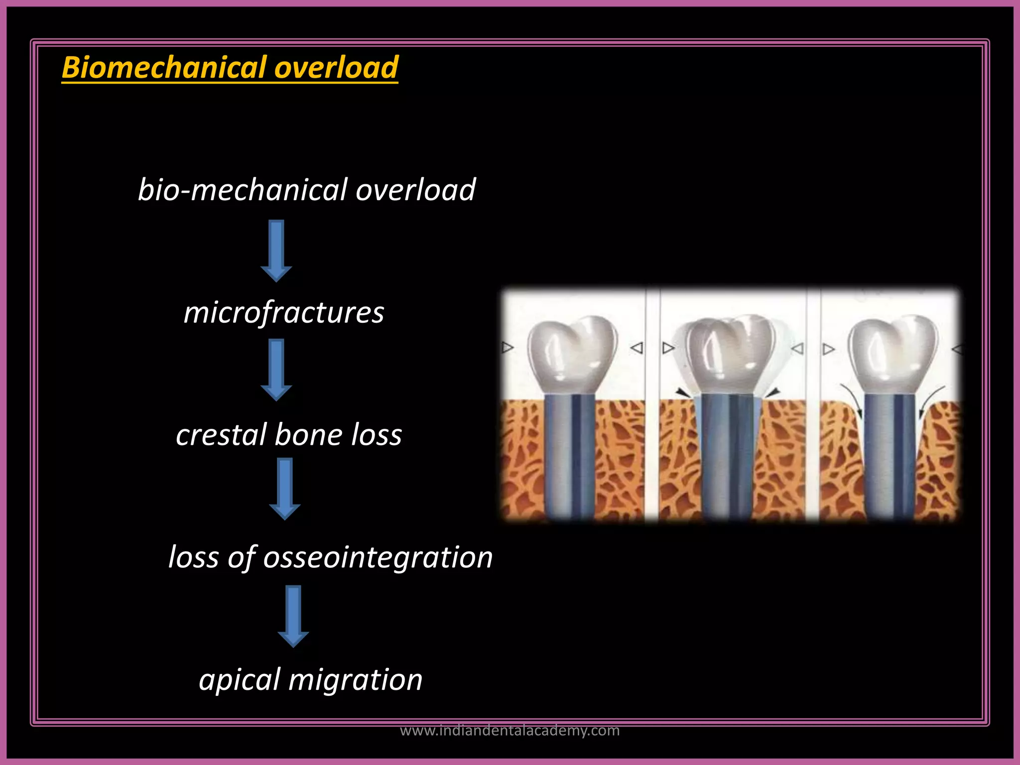 Biomechanical overload
bio-mechanical overload
microfractures
crestal bone loss
loss of osseointegration
apical migration
www.indiandentalacademy.com
 