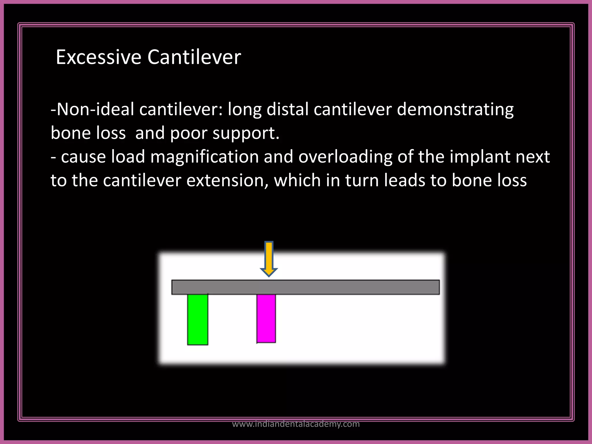 2
-Non-ideal cantilever: long distal cantilever demonstrating
bone loss and poor support.
- cause load magnification and overloading of the implant next
to the cantilever extension, which in turn leads to bone loss
Excessive Cantilever
www.indiandentalacademy.com
 