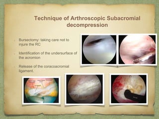Impingement syndrome | PPTX
