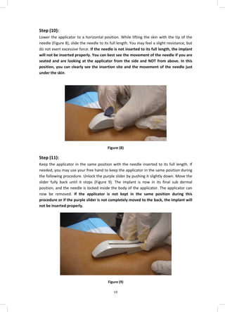 Implanon Radiograph Implanon