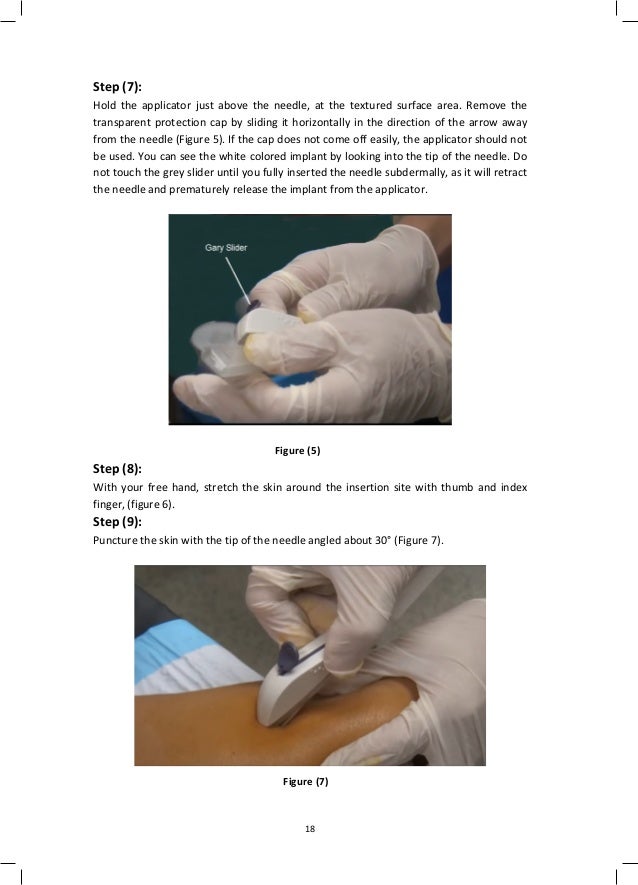 Diagnosis Code For Removal Of Neplanon maxing