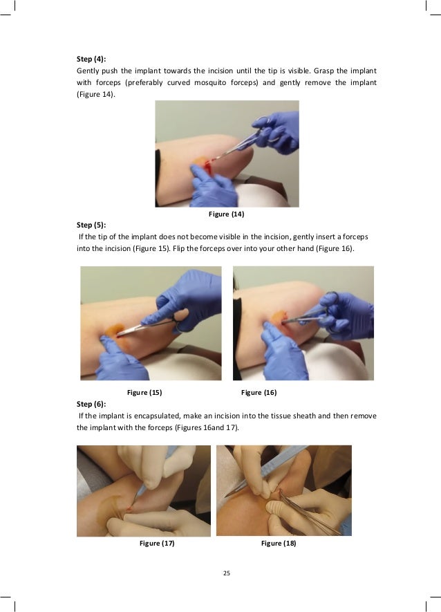 Implanon guideline 2017 Implanon guideline 2017