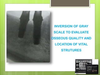 RADIOGRAPHIC IMAGING FOR DENTAL IMPLANT ASSESSMENT | PPTX
