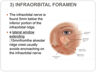 Inframmary Ridge Location applied anatomy for denta Implant | PPTX