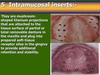 Projecting Tooth periodontology and dental implantology . | PPT