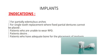 Sindle Rpd Basal IMPLANTs and technique................ .pptx