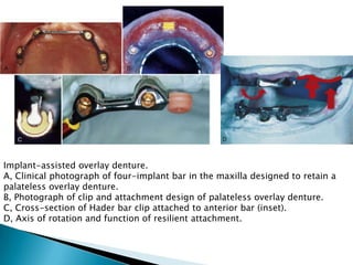 Implant-assisted overlay denture.
A, Clinical photograph of four-implant bar in the maxilla designed to retain a
palateless overlay denture.
B, Photograph of clip and attachment design of palateless overlay denture.
C, Cross-section of Hader bar clip attached to anterior bar (inset).
D, Axis of rotation and function of resilient attachment.
 