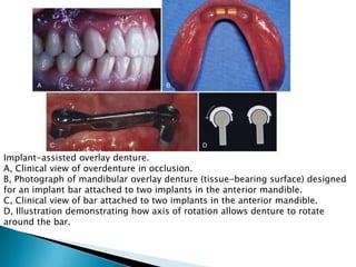 Implant-assisted overlay denture.
A, Clinical view of overdenture in occlusion.
B, Photograph of mandibular overlay denture (tissue-bearing surface) designed
for an implant bar attached to two implants in the anterior mandible.
C, Clinical view of bar attached to two implants in the anterior mandible.
D, Illustration demonstrating how axis of rotation allows denture to rotate
around the bar.
 