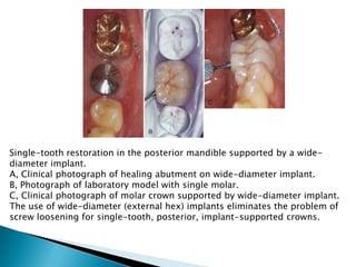 Single-tooth restoration in the posterior mandible supported by a wide-
diameter implant.
A, Clinical photograph of healing abutment on wide-diameter implant.
B, Photograph of laboratory model with single molar.
C, Clinical photograph of molar crown supported by wide-diameter implant.
The use of wide-diameter (external hex) implants eliminates the problem of
screw loosening for single-tooth, posterior, implant-supported crowns.
 