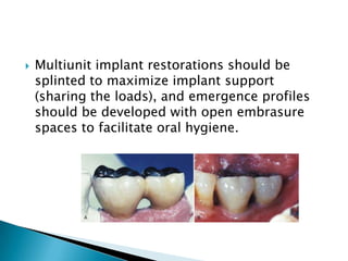  Multiunit implant restorations should be
splinted to maximize implant support
(sharing the loads), and emergence profiles
should be developed with open embrasure
spaces to facilitate oral hygiene.
 