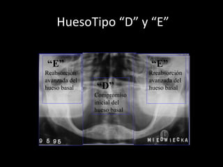 HuesoTipo “D” y “E”
“D”
Compromiso
inicial del
hueso basal
“E”
Reabsorción
avanzada del
hueso basal
“E”
Rreabsorción
avanzada del
hueso basal
 