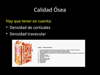 Calidad Ósea
Hay que tener en cuenta:
• Densidad de corticales
• Densidad travecular
 
