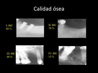 I: BIC
80 %
Calidad ósea
(BIC: Bone Implant Contact)
II: BIC
70 %
III: BIC
40 %
IV: BIC
15 %
 