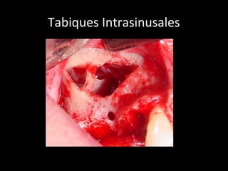 Tabiques Intrasinusales
 