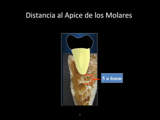 I
Distancia al Apice de los Molares
Según E. Oliver
Lingual Vestibular
5 a 6mm
 
