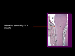 Area crítica inmediata para el
implante
 