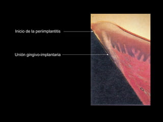 Unión gingivo-implantaria
Inicio de la periimplantitis
 