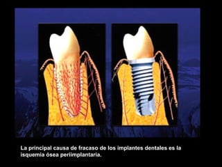 La principal causa de fracaso de los implantes dentales es la
isquemia ósea periimplantaria.
 