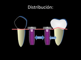 Distribución:
Distancias mínimas
3mm 1,5mm
 