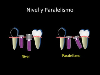 Nivel y Paralelismo
Nivel Paralelismo
 