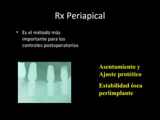 Rx Periapical
• Es el método más
importante para los
controles postoperatorios
Controlan
fundamentalmente:
Asentamiento y
Ajuste protético
Estabilidad ósea
periimplante
 
