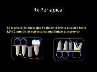 Rx Periapical
Altura de Hueso Disponible: Relación con
estructuras anatómicas nobles
Es la altura de hueso que va desde la cresta alveolar hasta
1,5 o 2 mm de las estructuras anatómicas a preservar
 
