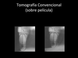 Tomografía Convencional
(sobre película)
Poseen distorsiones homogéneas, estandarizadas
y calculadas para cada tipo de aparato
 