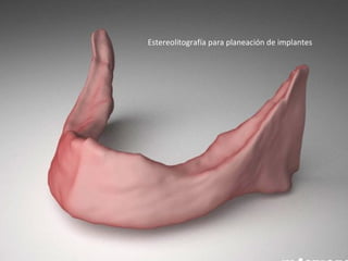Estereolitografía para planeación de implantes
 