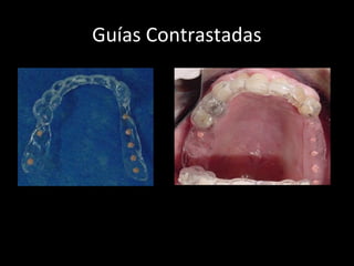 Guías Contrastadas
Guía con elementos
radioopacos
 