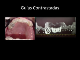 Guías Contrastadas
Colocación de la guía
en el momento de las
exposiciones
Imágen del panorexes
central
 