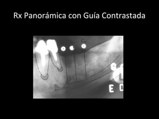 Rx Panorámica con Guía Contrastada
 