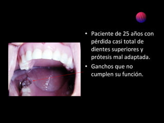 • Paciente de 25 años con
pérdida casi total de
dientes superiores y
prótesis mal adaptada.
• Ganchos que no
cumplen su función.
 