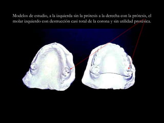 Modelos de estudio, a la izquierda sin la prótesis a la derecha con la prótesis, el
molar izquierdo con destrucción casi total de la corona y sin utilidad protésica.
 
