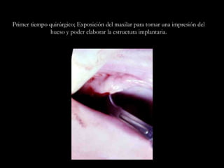 Primer tiempo quirúrgico; Exposición del maxilar para tomar una impresión del
hueso y poder elaborar la estructura implantaria.
 