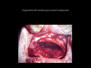 Exposición del maxilar para tomar la impresión
 