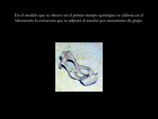 En el modelo que se obtuvo en el primer tiempo quirúrgico se elabora en el
laboratorio la estructura que se adptará al maxilar por mecanismo de grapa.
 