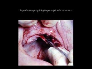 Segundo tiempo quirúrgico para aplicar la estructura.
 