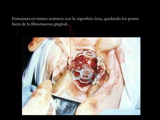 Estructura en íntimo contacto con la superficie ósea, quedando los postes
fuera de la fibromucosa gingival..
 