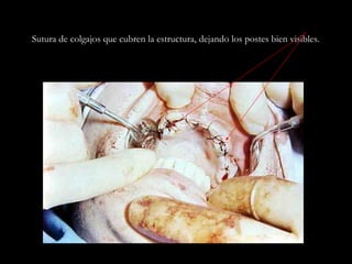 Sutura de colgajos que cubren la estructura, dejando los postes bien visibles.
 