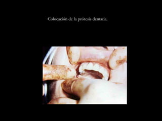 Colocación de la prótesis dentaria.
 