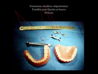 Estructuras metálicas subperiósticas:
Tornillos para fijación en hueso:
Prótesis:
 