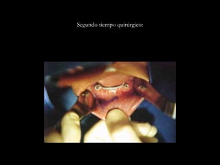 Segundo tiempo quirúrgico:
 