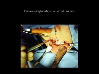 Estructura implantada por debajo del periostio:
 