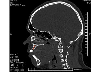 Lingitud de hueso
Disponible 20 mm.
 